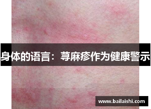 身体的语言：荨麻疹作为健康警示